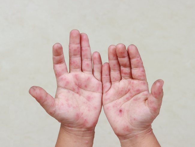 解封防疫鬆懈! 每週萬人感染腸病毒 醫師呼籲「勤洗手保健康」 | 華視市場快訊